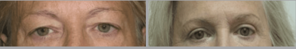 Screenshot 2024-08-09 at 9.37.15 PM Eyelid Surgery or Blepharoplasty in Ventura, CA